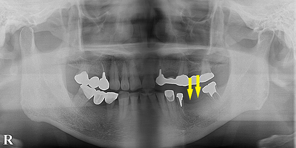 骨幅を拡げる手術で、細い骨でもインプラント可能に｜インプラント治療で選ばれる名古屋の歯科医院