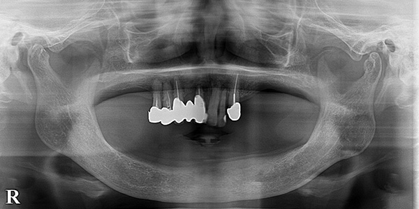 インプラントで義歯を安定させ、咬める義歯に