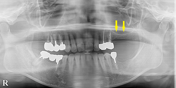 骨造成で上顎の薄い骨でも、インプラントを可能に1枚目｜インプラント治療で選ばれる名古屋の歯科医院
