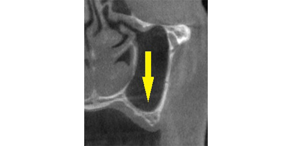 骨造成で上顎の薄い骨でも、インプラントを可能に2枚目｜インプラント治療で選ばれる名古屋の歯科医院