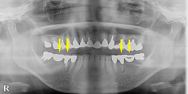 抜歯即時インプラント埋入で、治療期間の短縮を