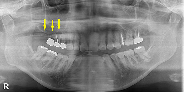 上顎臼歯の薄い骨を、骨造成でインプラント可能に1