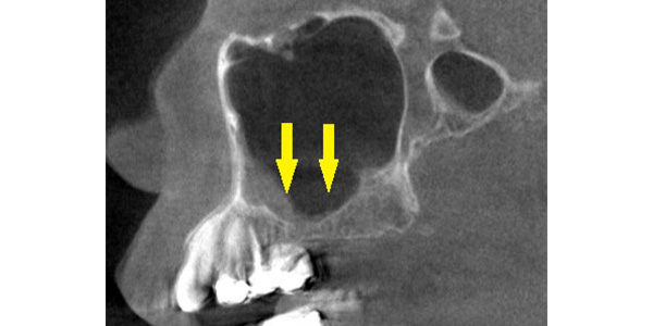 上顎臼歯の薄い骨を、骨造成でインプラント可能に2