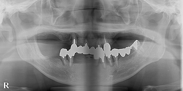 義歯をインプラントで安定させてよく咬めるように｜インプラント治療で選ばれる名古屋の歯科医院