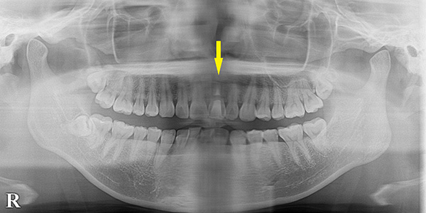 抜歯即時インプラント埋入で、骨吸収も抑制