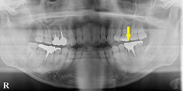 大臼歯1本欠損を、ブリッジでなく、インプラントで｜インプラント治療で選ばれる名古屋の歯科医院