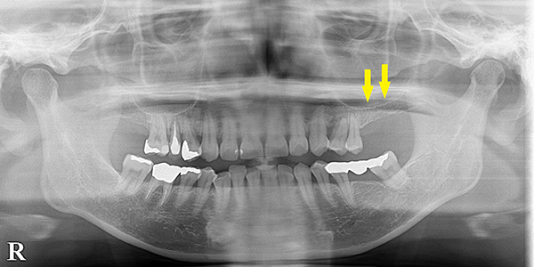 骨造成が成功し、上顎臼歯にインプラント埋入できました｜インプラント治療で選ばれる名古屋の歯科医院