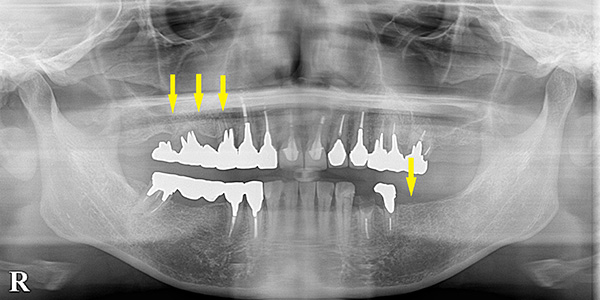 少しの骨不足は、少量の骨造成でインプラント治療を｜インプラント治療で選ばれる名古屋の歯科医院