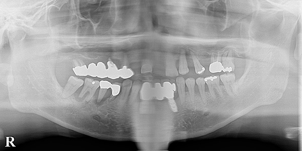 骨の少ない難症例も、骨造成で固定式の歯を回復｜インプラント治療で選ばれる名古屋の歯科医院