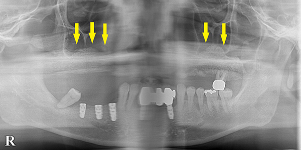 骨の少ない難症例も、骨造成で固定式の歯を回復2