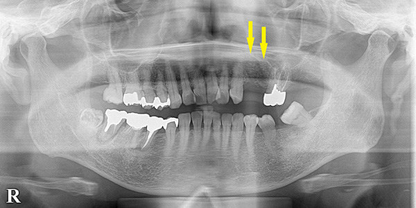 一部のみ骨が薄い場合には、少量の骨造成術でインプラントを｜インプラント治療で選ばれる名古屋の歯科医院