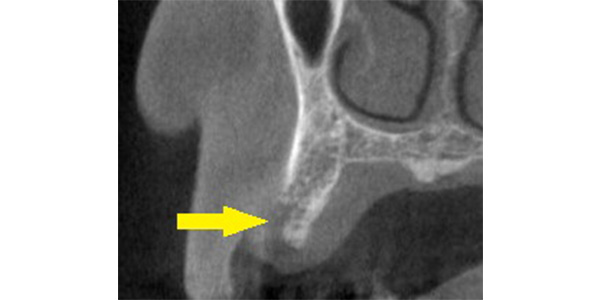 一部のみ骨が薄い場合には、少量の骨造成術でインプラントを｜インプラント治療で選ばれる名古屋の歯科医院
