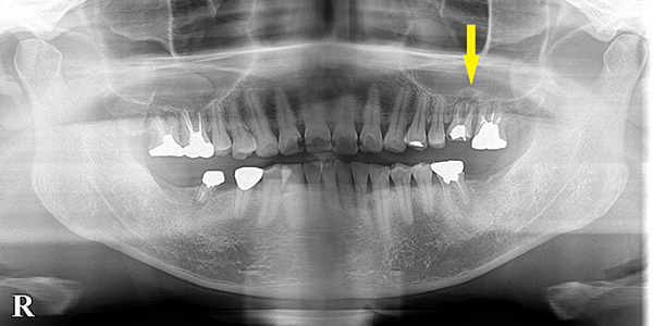骨不足の臼歯1本でも、骨造成で、インプラントを可能に1