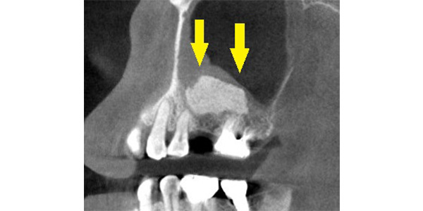 骨不足の臼歯1本でも、骨造成で、インプラントを可能に2