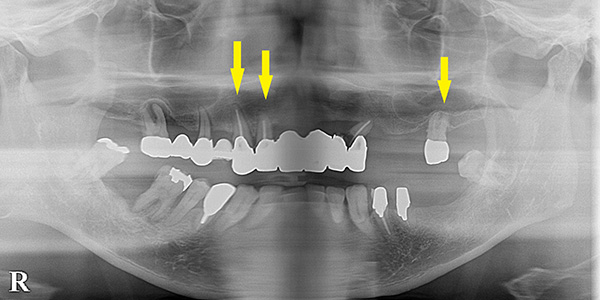 ボロボロのお口の中も、インプラントでよく噛めるように｜インプラント治療で選ばれる名古屋の歯科医院