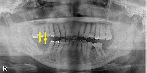 骨のない部位に、骨を移植して、インプラントを可能に｜インプラント治療で選ばれる名古屋の歯科医院