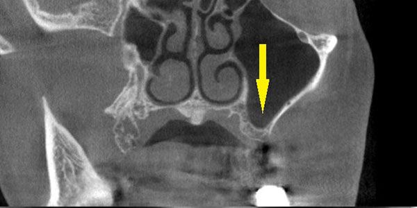 CTを撮影して、初めて分かる。骨が薄い場合は骨造成を｜インプラント治療で選ばれる名古屋の歯科医院