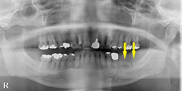 必要に応じて、インプラント周囲に固い歯肉を獲得するための手術を行います