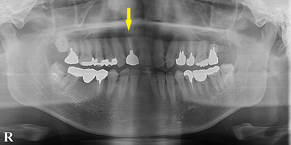 前歯は、抜歯即時インプラント埋入で治療期間の短縮を