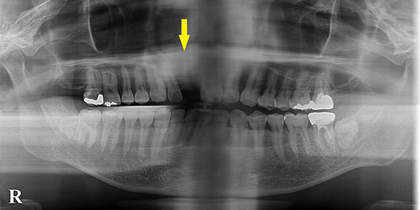 前歯の骨が薄い場合は、厚みを増やす骨造成術でインプラントを可能に1