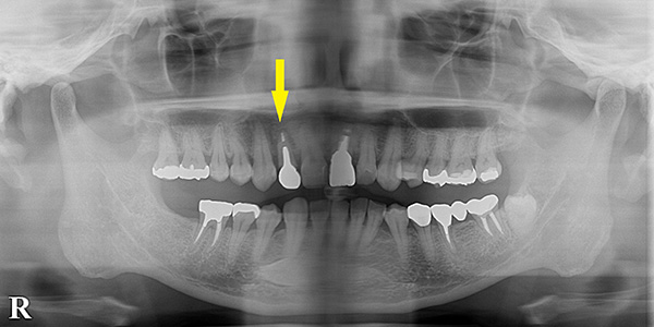 前歯を抜歯即時インプラント埋入で治療