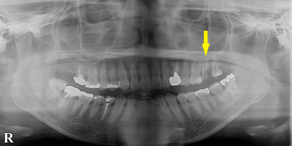 第二大臼歯も、骨造成をして、インプラント治療がお勧め