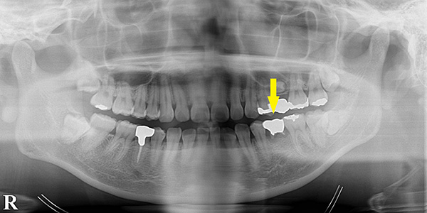 先天性欠損の歯を、インプラントで回復