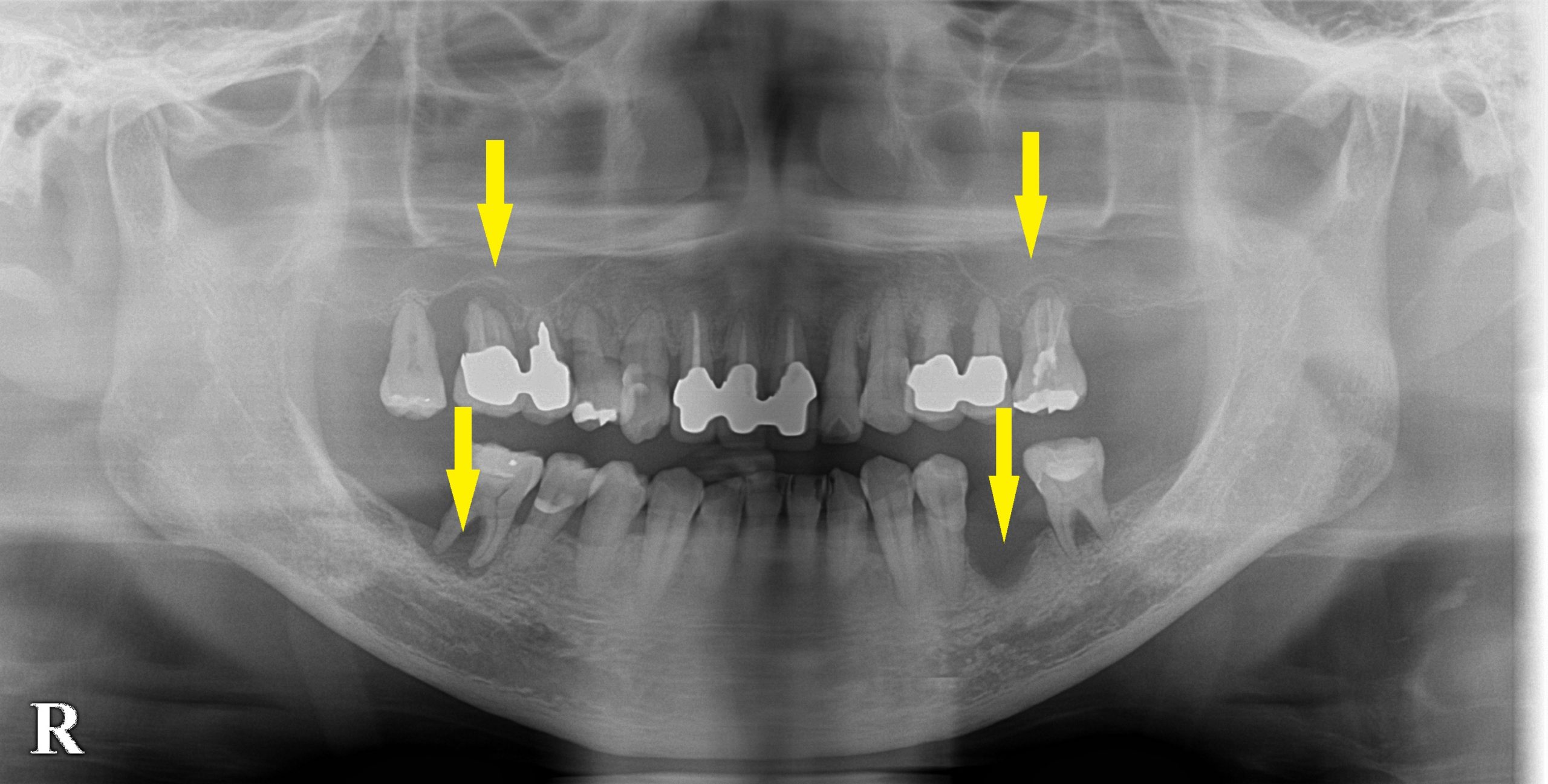 重度の骨吸収もあきらめないで、骨造成でインプラントを｜インプラント治療で選ばれる名古屋の歯科医院