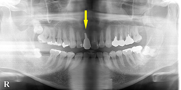 抜歯即時埋入で、治療期間の短縮と骨の喪失抑制を