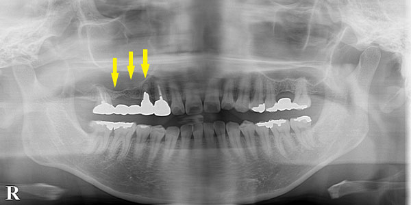 上顎臼歯の薄い骨は、サイナスリフトで骨造成