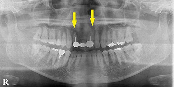 前歯部のブリッジも、即時埋入でインプラントに1