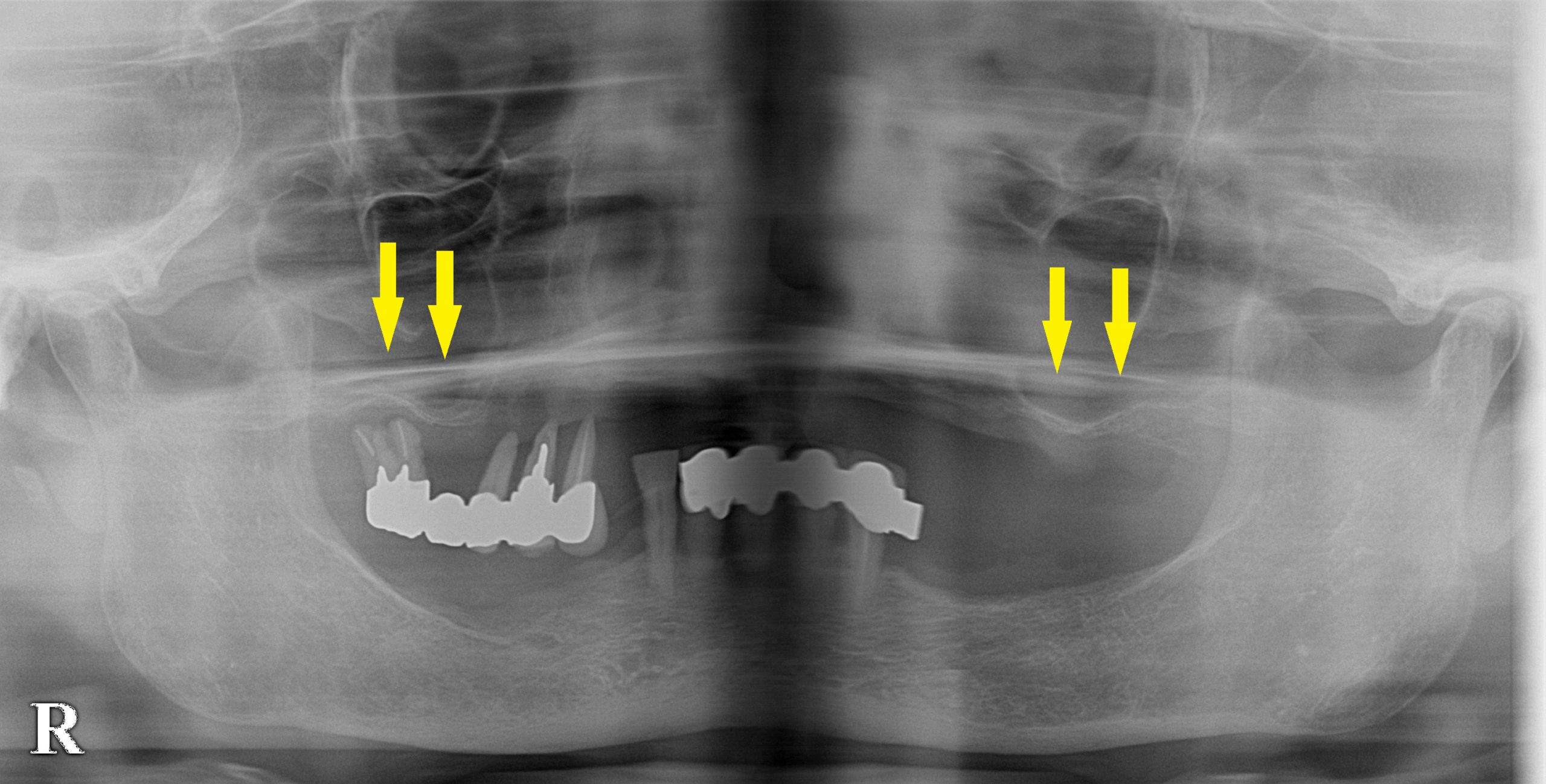 4本だけインプラントを埋入して、総義歯の維持装置を｜インプラント治療で選ばれる名古屋の歯科医院