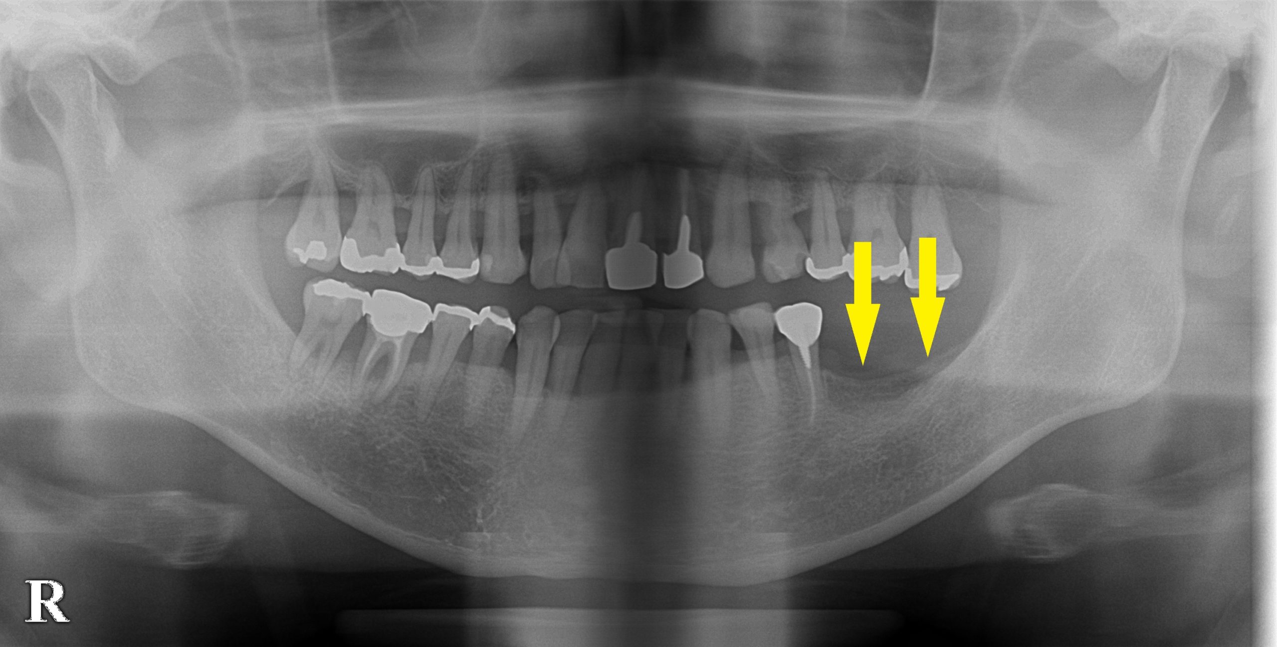 歯周病で失った歯を、インプラント治療で回復｜インプラント治療で選ばれる名古屋の歯科医院