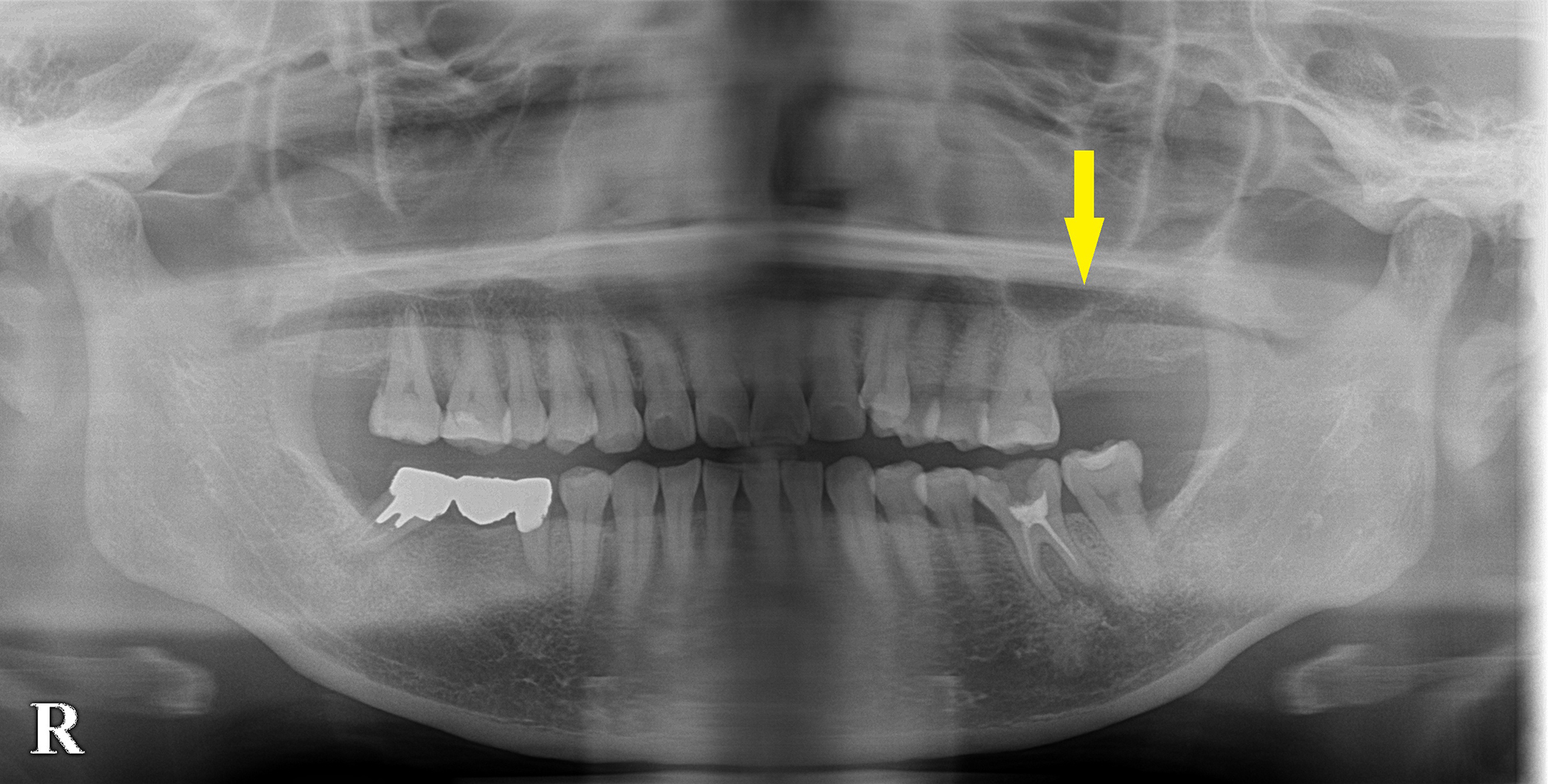 上顎第二大臼歯もソケットリフトでインプラントを｜インプラント治療で選ばれる名古屋の歯科医院