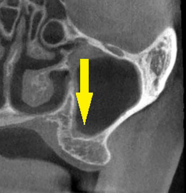 上顎第二大臼歯もソケットリフトでインプラントを｜インプラント治療で選ばれる名古屋の歯科医院