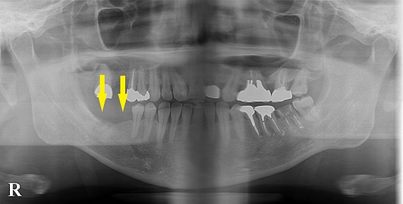 下顎大臼歯、骨に合わせてやや短めのインプラント