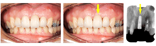 上顎前歯2本のうち向かって右の歯がインプラント