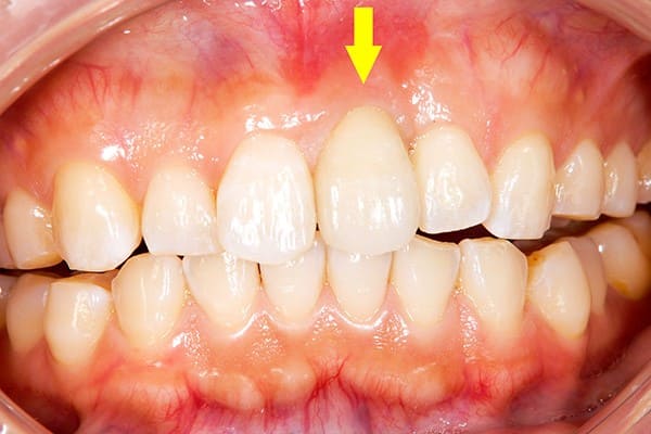 右側インプラントの歯はやや歯肉が上がり歯が長い