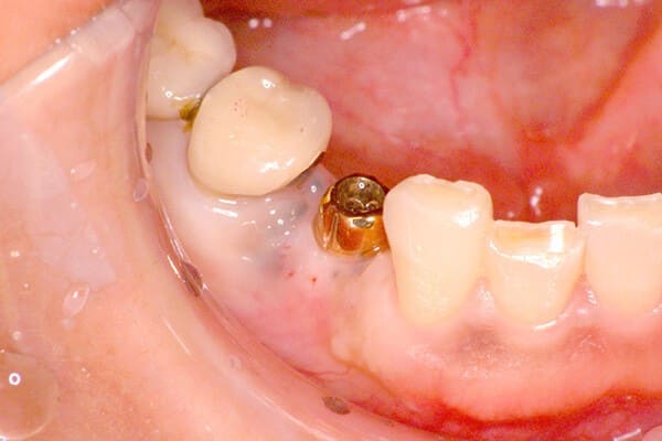 カスタムメイドアバットメントを連結、セラミックの歯を装着する前